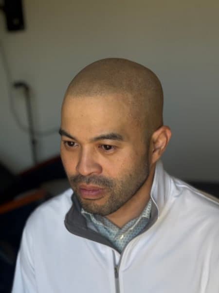 Fort Worth Scalp Micropigmentation photo 1